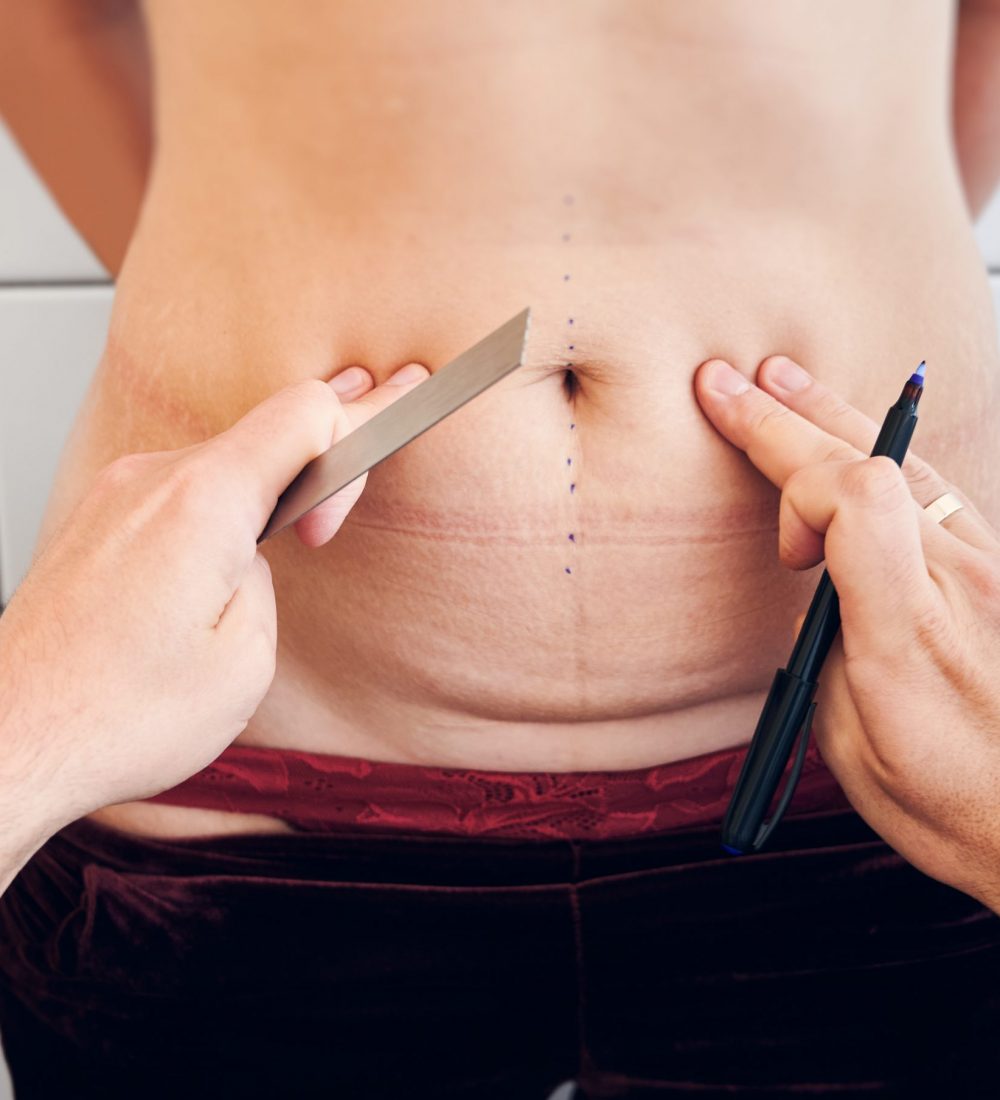Close up of plastic surgeon hands holding ruler and marker pen while touching woman belly. Doctor measuring and marking abdomen of female patient before aesthetic surgery. Concept of abdominoplasty.